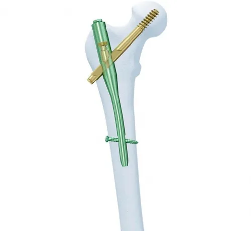 Synthes - 456.454s - Synthes 12mm/125 Deg Ti Cannulated Troch Fixation Nail 340mm/Right-Sterile